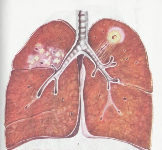 Туберкулез по-прежнему опасен